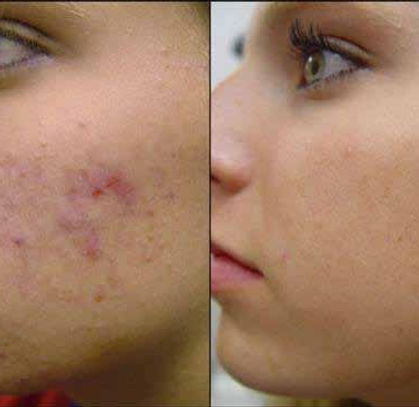 a girl with acne before and after