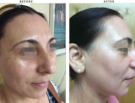 before and after picture with a woman with skin rejuvanation