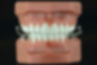 jaw jumpers by melbourne orthodontist