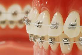 self ligating braces melbourne ortho