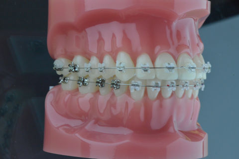 Ceramic Braces braces melbourne ortho