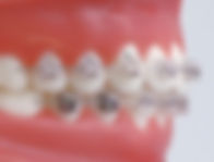 Ceramic Braces melbourne orthodontist