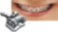 self ligating braces melbourne orthodontist