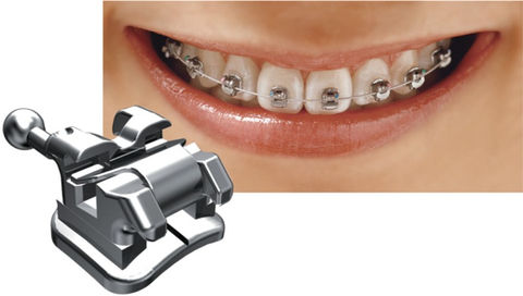 metal Braces melbourne ortho