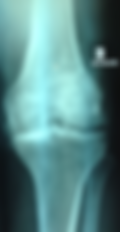 arthrose-du-genou