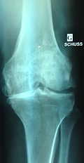 arthrose-du-genou
