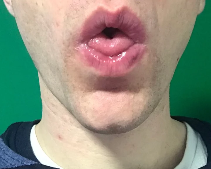 Photo of a close up of a man's mouth with tongue in shape of a 'u'