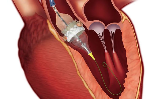 Transcatheter-Aortic-Valve-Replacement.jpg