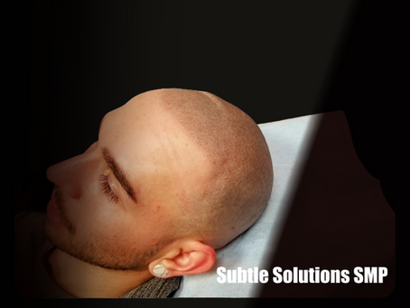 Concealing Alopecia Areata with Scalp Micropigmentation: Subtle Solutions SMP in Scottsdale, Arizona