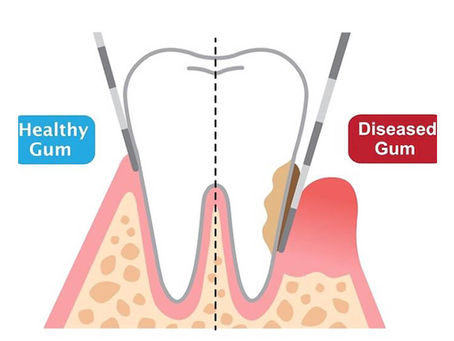 Gum Disease Treatment Melbourne