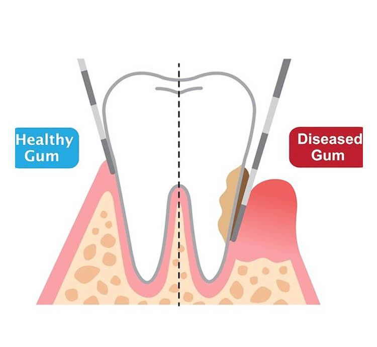 Gum Disease Treatment Melbourne