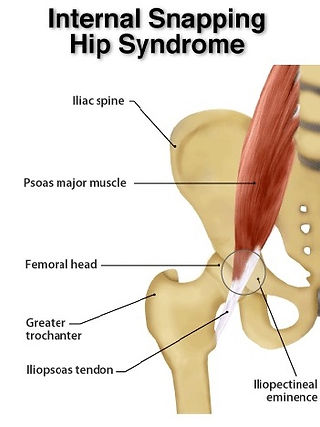 internal-snapping-hip-syndrome