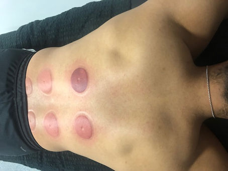 Cupping Therapy... The Trending Holistic Therapy