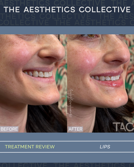 Before and after lip filler treatment, patient of The Aesthetics Collective in Lincolnshire, IL (2 of 8)