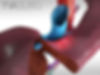 extLeftHepatectomy_comp_03.jpg
