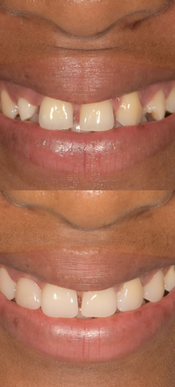 Composites dentaire sourire