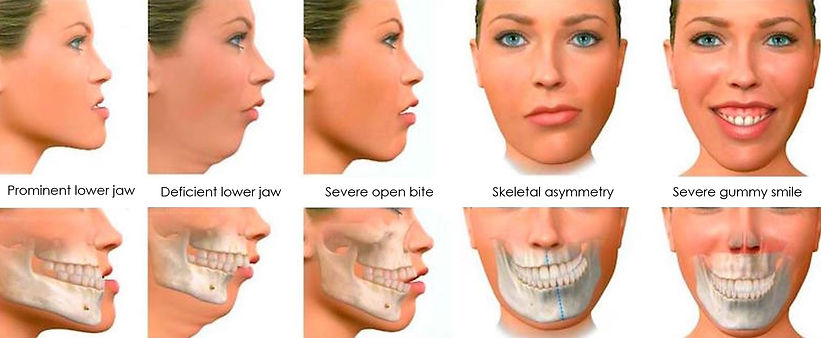 orthognathic surgery2.jpg