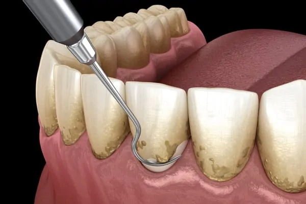Dental Cleaning.webp
