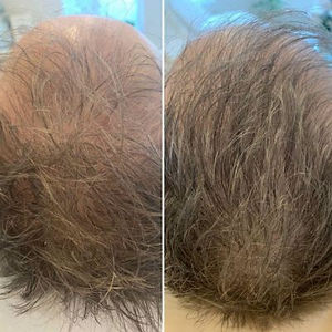 Hairfiller-fore-efter-JQ.Klinik-peuk6gbrtr3k41jxp4naqa9ryfslevm292fjb5yc9s.jpg