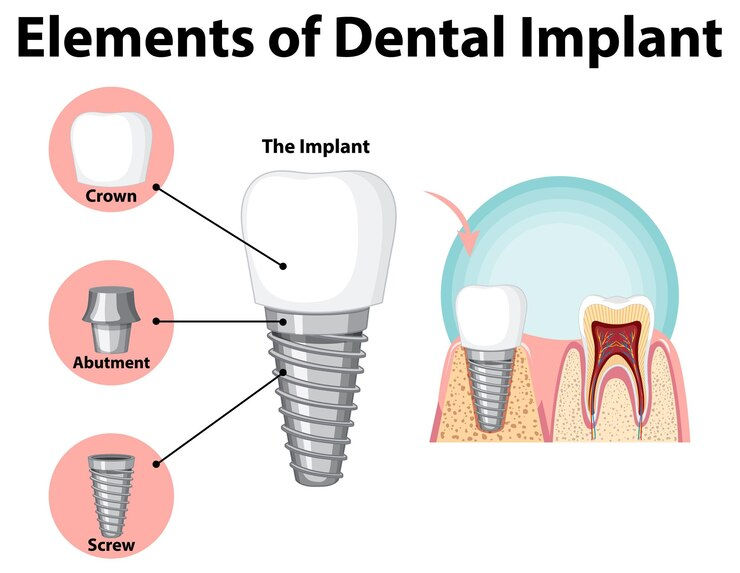dental impliment.jpg