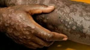 Person's hand on leg showing vitiligo