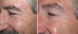 Toxina botulinica foto 9