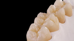 Zirconia Prettau Anterior