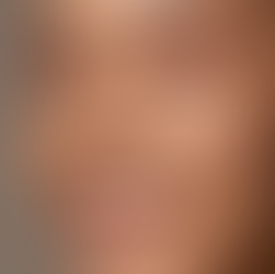 How Does Botox Work? Science of Anti-Wrinkle Injections | Joburg Beauty Doctor