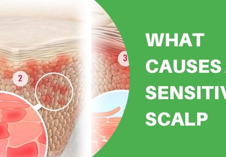 Scalp Sensitivity and Tender Scalp