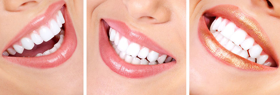 teeth_whitening1.jpg