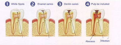 Stages of Cavity Graph