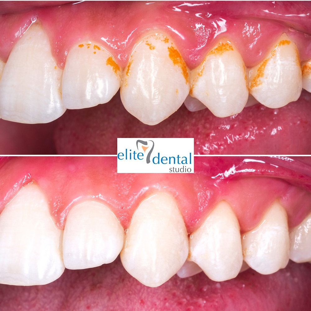 Dental Hygiene clean What is a hygiene clean, why is it beneficial and what do we offer?