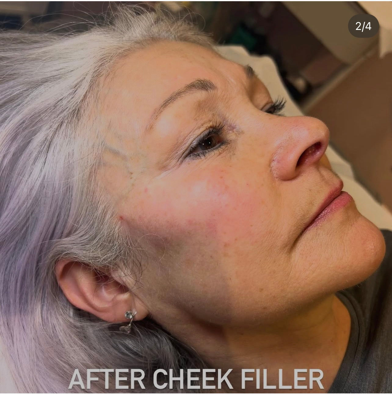 Cheek Augmentation (price starts from)