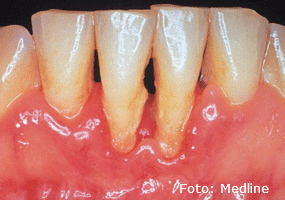 Periodontitis. Área Bucal
