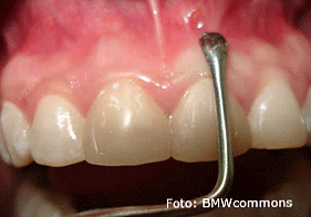 Fístula bucal. Área Bucal