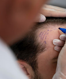 Hair Transplant