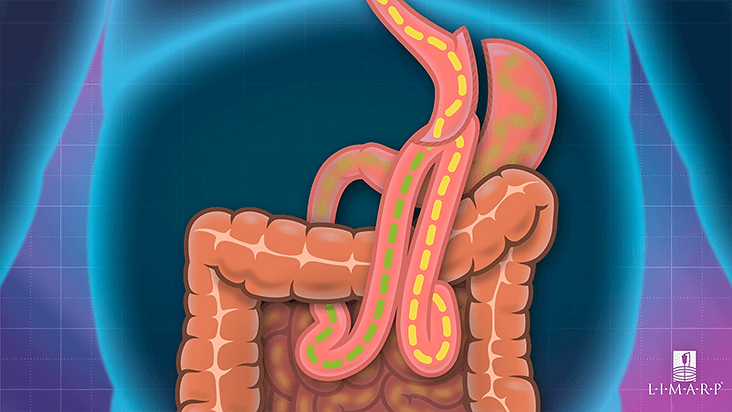 mini-bypass-surgery-tijuana-mexico.png
