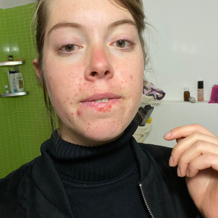 My Health Journey: Overeating, Acne, Juice Fasting & Going Fruitarian