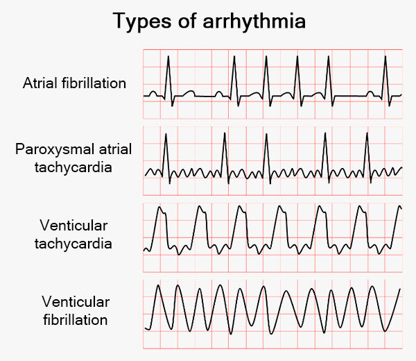 Post people and arrhythmia