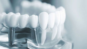 Dental implant 2.jpg