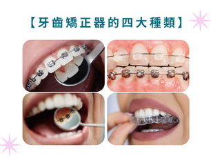 牙 齒矯正器的四大種類