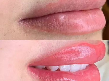 Dudakta oluşan pigment kaybını gidermenin en iyi yolu