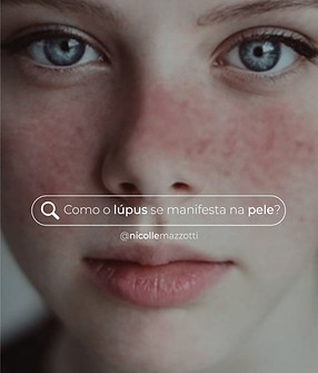 LUPUS.jpg