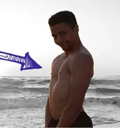TSM Myth with Pectus Excavatum