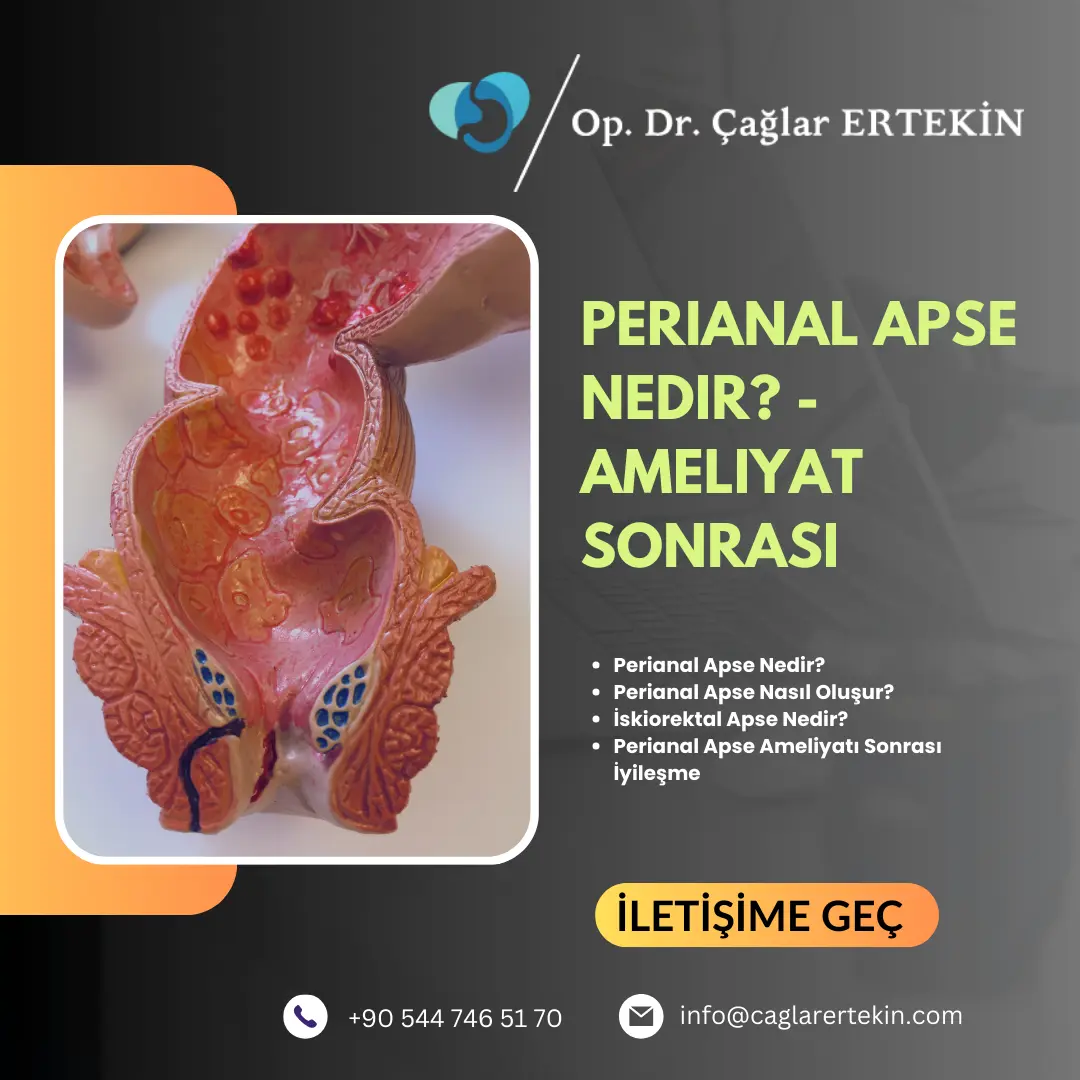 Gümüs Nitrat ile Ameliyatsız Anal Fistül Tedavisi