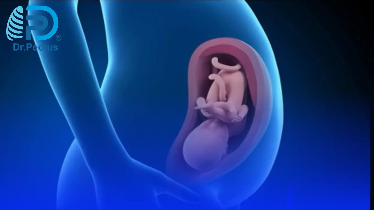 Intrauterine Pressure and Pectus Excavatum