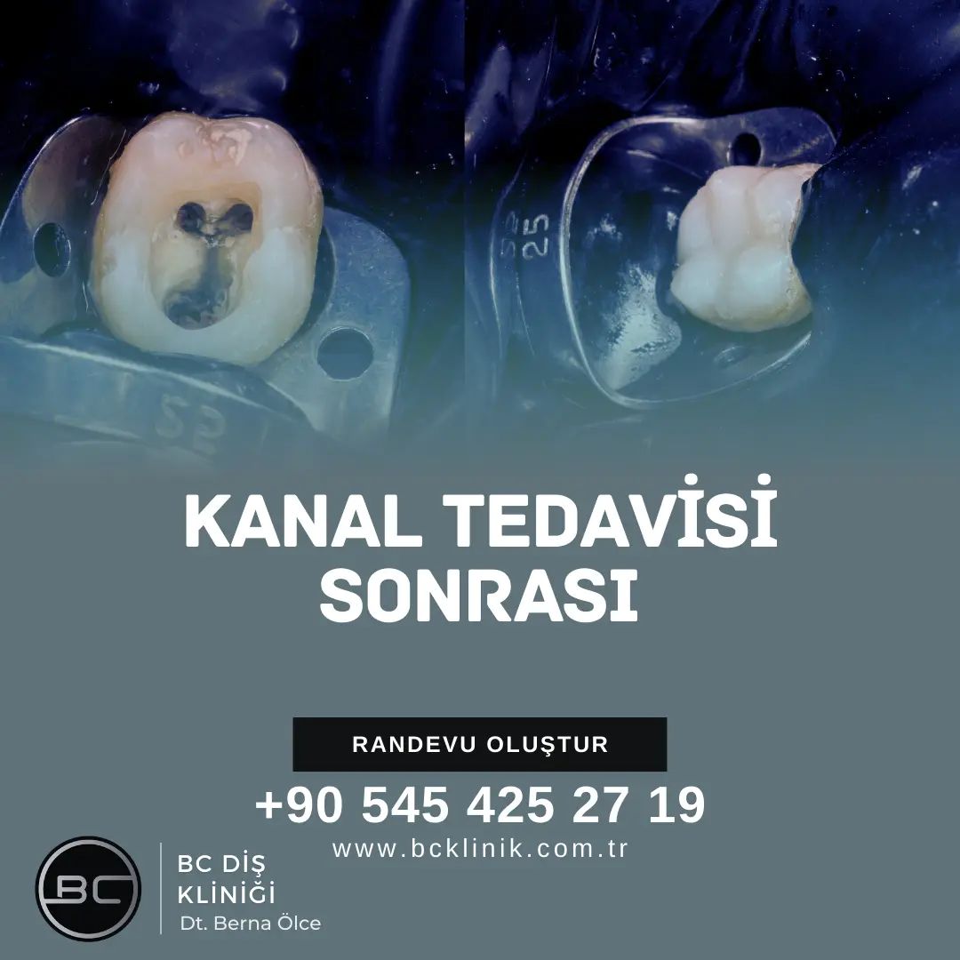 Kanal Tedavisi Sonrası Diş Üstüne Basamama
