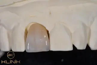 metal destekli porselen diş