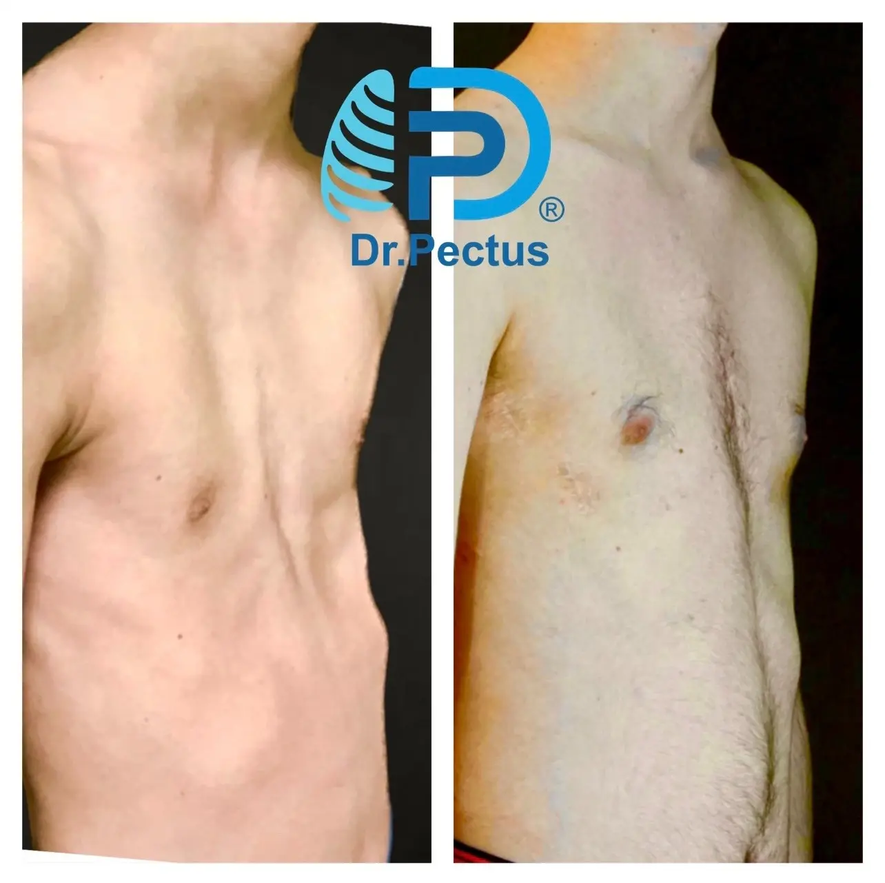 acquired platythorax-anteroposterior flattening of the chest wall