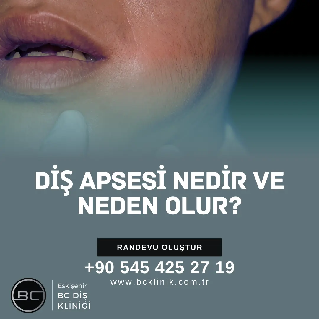 diş çekimi sonrası iltihap 